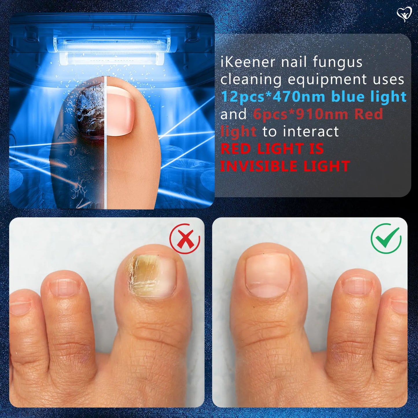 Nail Fungus Cleaning Laser Device Time Display 470nm Blue Lightand 910nm Repair Damaged Discolored Thick Fingernails Foot Care