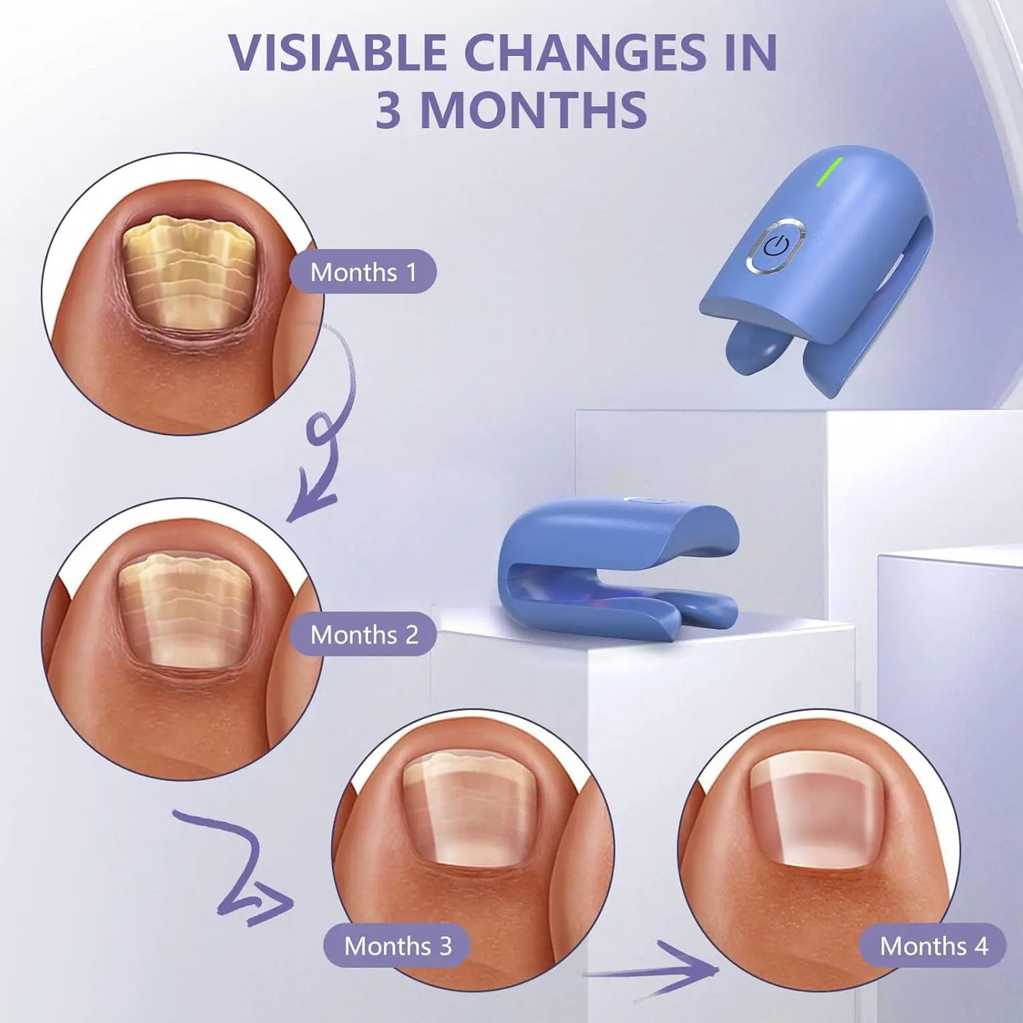 KTS Fungal Nail Laser Device Repair Fast Nails Fungus Onychomycosis Repair Toenail Fingernail Removes Nail Fungus Foot Care