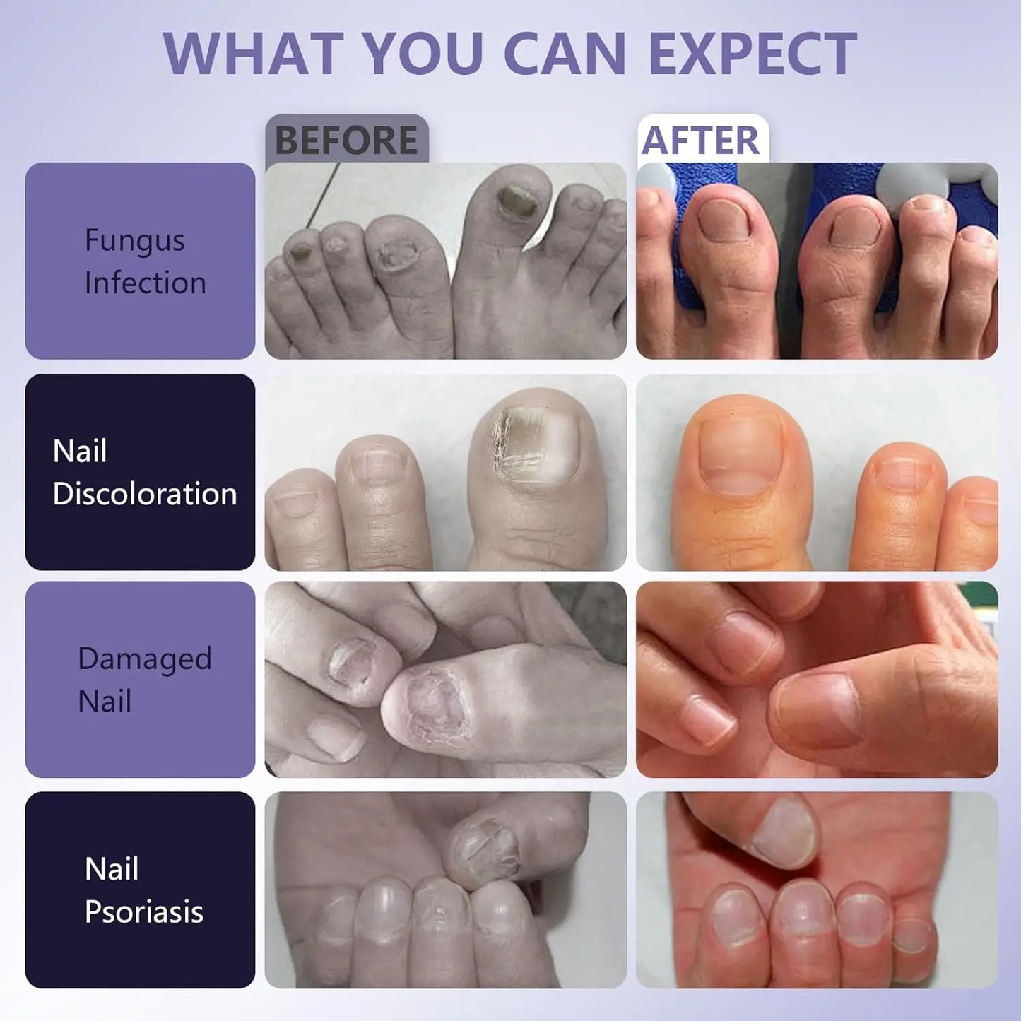 KTS Fungal Nail Laser Device Repair Fast Nails Fungus Onychomycosis Repair Toenail Fingernail Removes Nail Fungus Foot Care